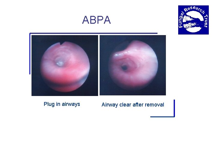 ABPA Plug in airways Airway clear after removal 