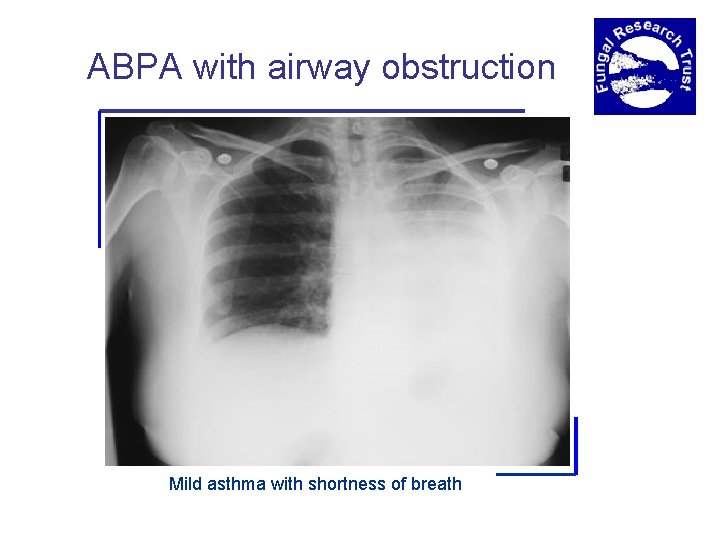 ABPA with airway obstruction Mild asthma with shortness of breath 