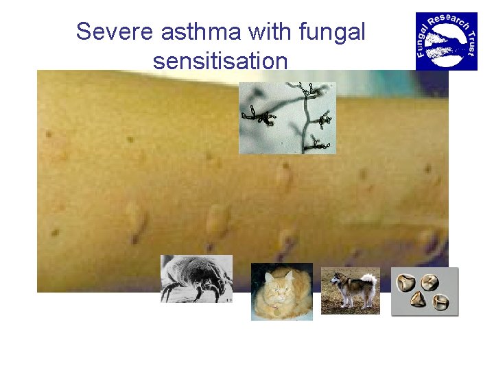 Severe asthma with fungal sensitisation 