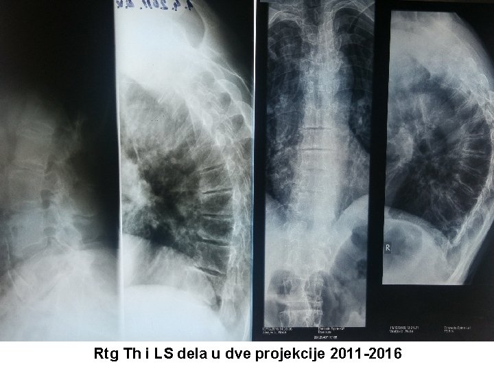 Rtg Th i LS dela u dve projekcije 2011 -2016 