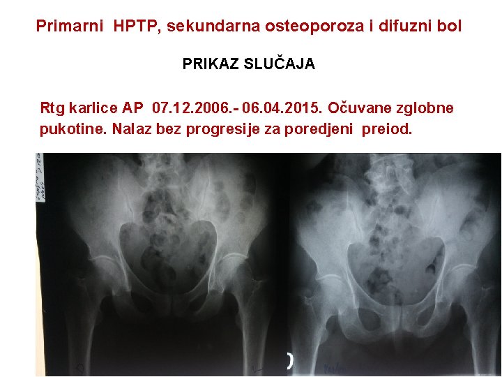 Primarni HPTP, sekundarna osteoporoza i difuzni bol PRIKAZ SLUČAJA Rtg karlice AP 07. 12.