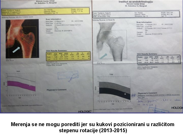 Merenja se ne mogu porediti jer su kukovi pozicionirani u različitom stepenu rotacije (2013