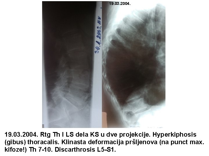 19. 03. 2004. Rtg Th I LS dela KS u dve projekcije. Hyperkiphosis (gibus)