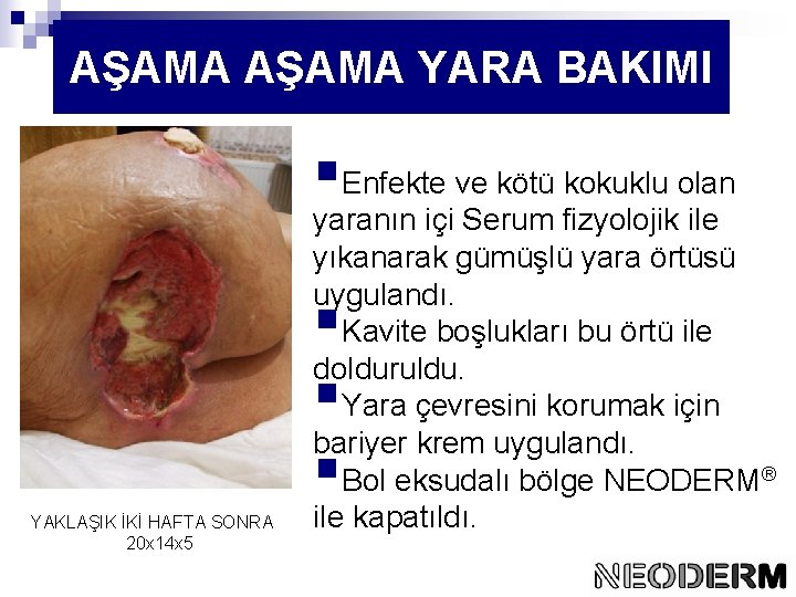 AŞAMA YARA BAKIMI §Enfekte ve kötü kokuklu olan yaranın içi Serum fizyolojik ile yıkanarak