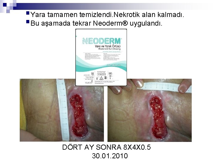 §Yara tamamen temizlendi. Nekrotik alan kalmadı. §Bu aşamada tekrar Neoderm® uygulandı. DÖRT AY SONRA