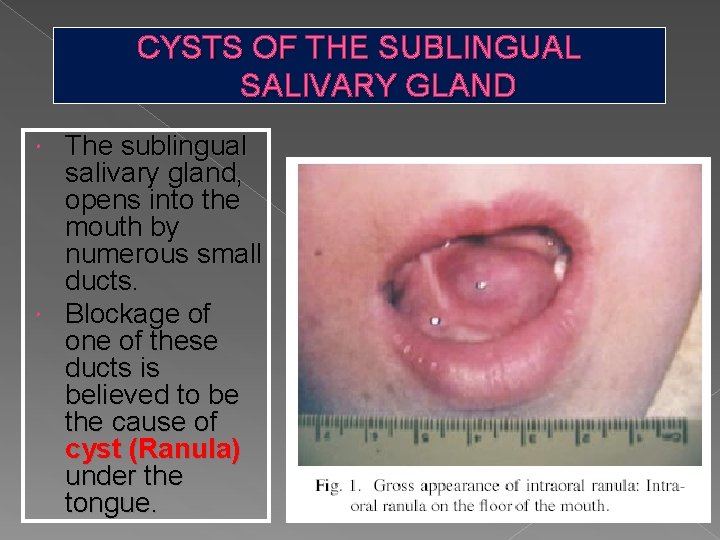 CYSTS OF THE SUBLINGUAL SALIVARY GLAND The sublingual salivary gland, opens into the mouth