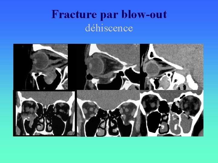 Fracture par blow-out déhiscence 