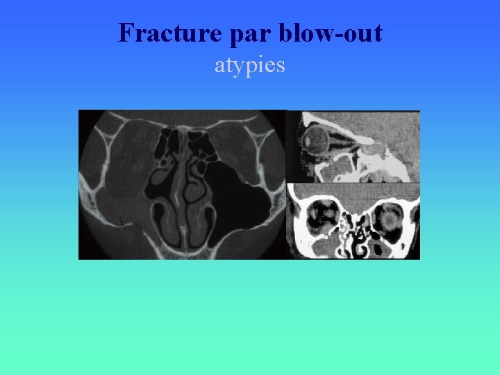 Fracture par blow-out atypies 