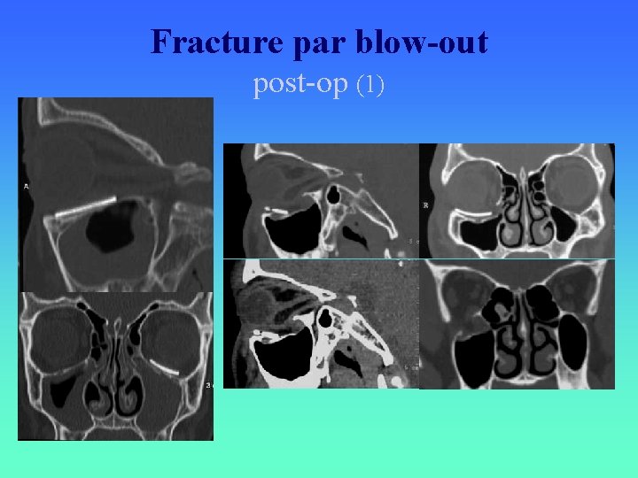 Fracture par blow-out post-op (1) 