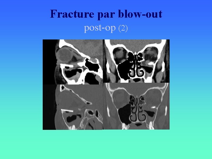 Fracture par blow-out post-op (2) 