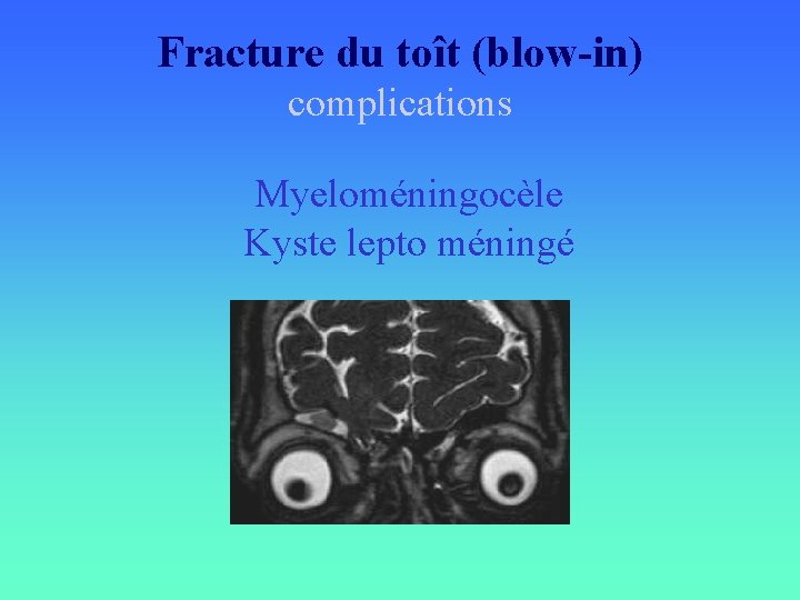 Fracture du toît (blow-in) complications Myeloméningocèle Kyste lepto méningé 