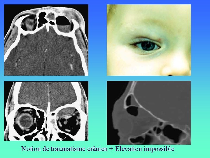 Notion de traumatisme crânien + Elevation impossible 