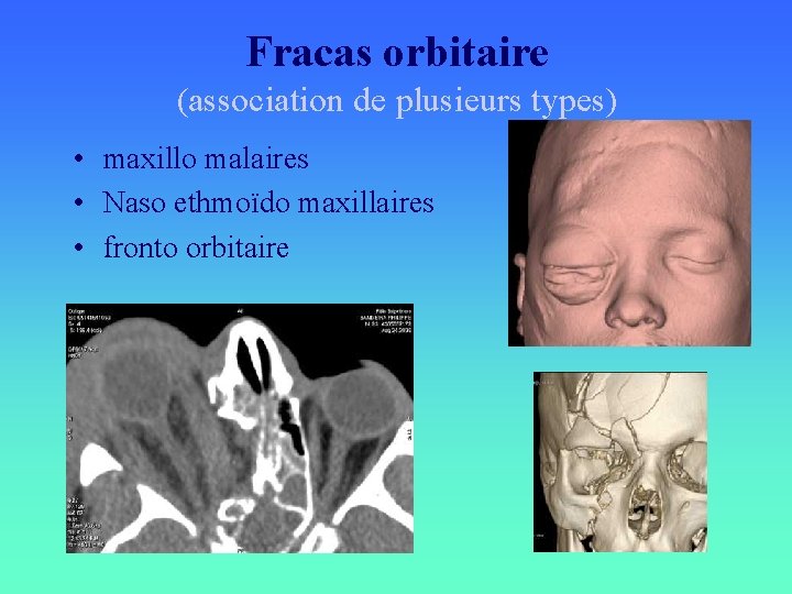 Fracas orbitaire (association de plusieurs types) • maxillo malaires • Naso ethmoïdo maxillaires •