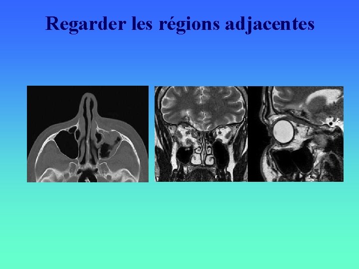 Regarder les régions adjacentes 