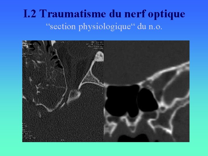 I. 2 Traumatisme du nerf optique “section physiologique“ du n. o. 