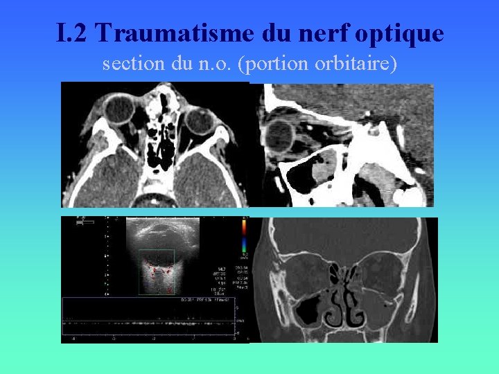 I. 2 Traumatisme du nerf optique section du n. o. (portion orbitaire) 