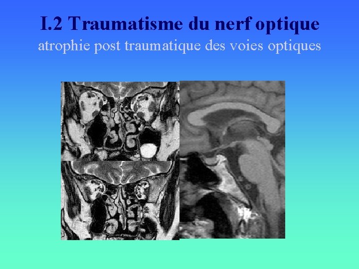 I. 2 Traumatisme du nerf optique atrophie post traumatique des voies optiques 