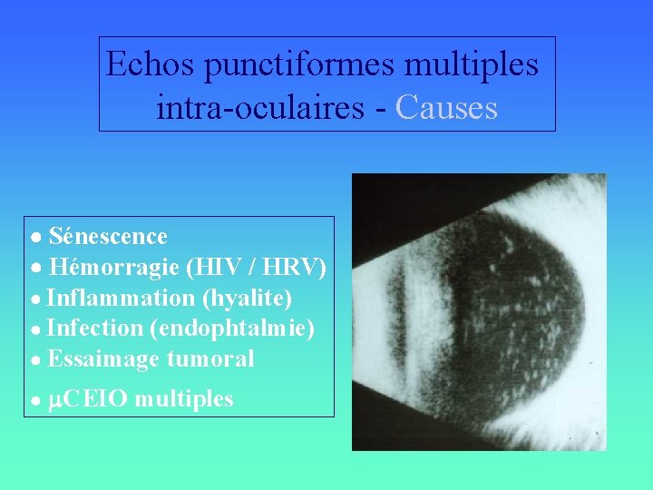 Echos punctiformes multiples intra-oculaires - Causes Sénescence Hémorragie (HIV / HRV) Inflammation (hyalite) Infection