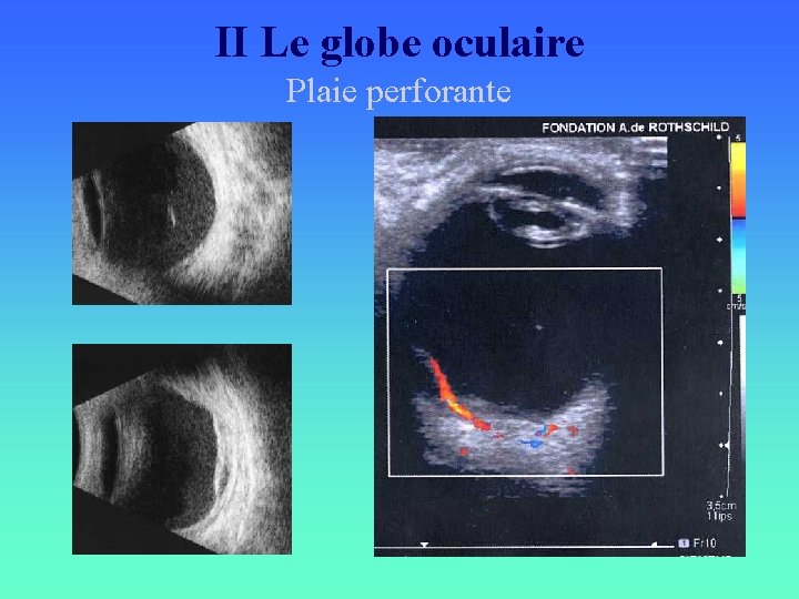 II Le globe oculaire Plaie perforante 