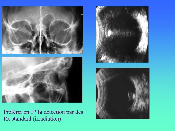 Préférer en 1 er la détection par des Rx standard (irradiation) 