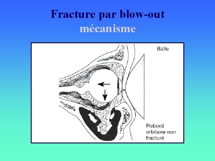 Fracture par blow-out mécanisme 