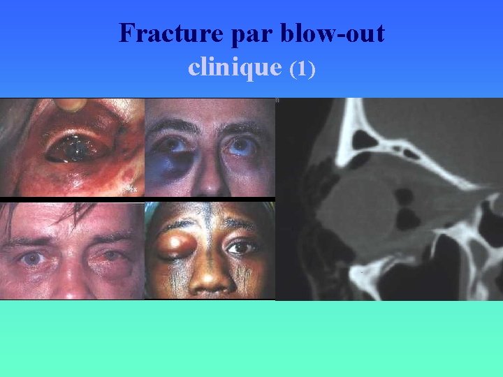 Fracture par blow-out clinique (1) 