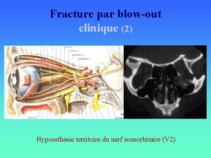 Fracture par blow-out clinique (2) Hypoesthésie territoire du nerf sousorbitaire (V 2) 