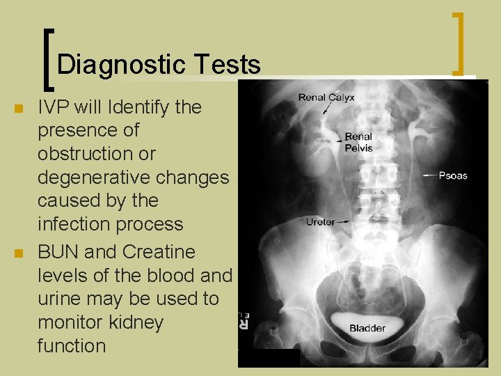 Diagnostic Tests n n IVP will Identify the presence of obstruction or degenerative changes