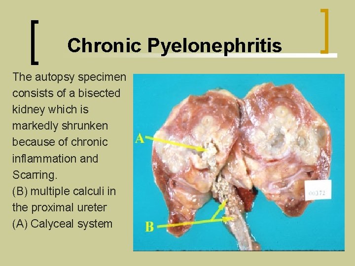  Chronic Pyelonephritis The autopsy specimen consists of a bisected kidney which is markedly