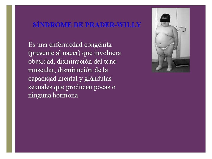 SÍNDROME DE PRADER-WILLY Es una enfermedad congénita (presente al nacer) que involucra obesidad, disminución