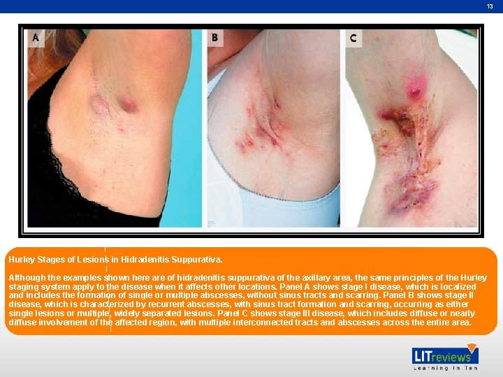 13 Hurley Stages of Lesions in Hidradenitis Suppurativa. Although the examples shown here are