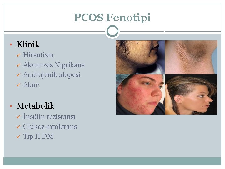 PCOS Fenotipi • Klinik ü ü Hirsutizm Akantozis Nigrikans Androjenik alopesi Akne • Metabolik