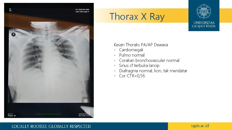 Thorax X Ray Kesan Thoraks PA/AP Dewasa - Cardiomegali - Pulmo normal - Corakan