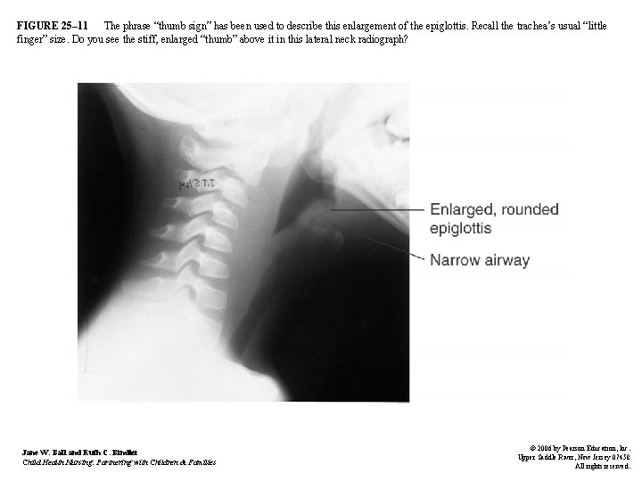 FIGURE 25– 11 The phrase “thumb sign” has been used to describe this enlargement