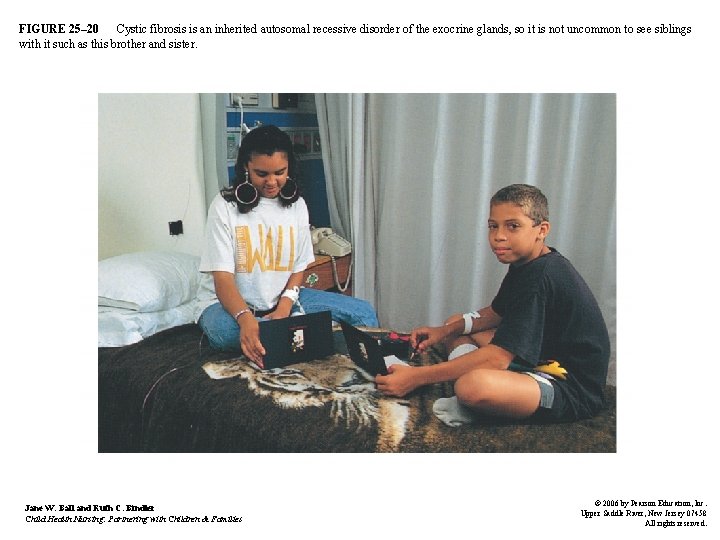 FIGURE 25– 20 Cystic fibrosis is an inherited autosomal recessive disorder of the exocrine