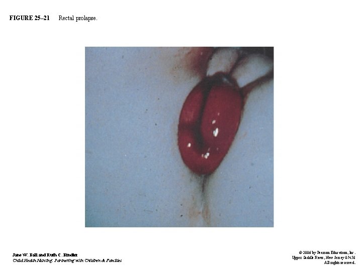FIGURE 25– 21 Rectal prolapse. Jane W. Ball and Ruth C. Bindler Child Health