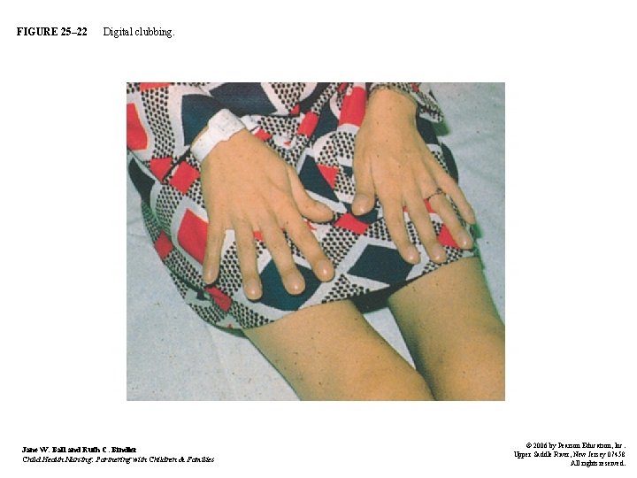 FIGURE 25– 22 Digital clubbing. Jane W. Ball and Ruth C. Bindler Child Health