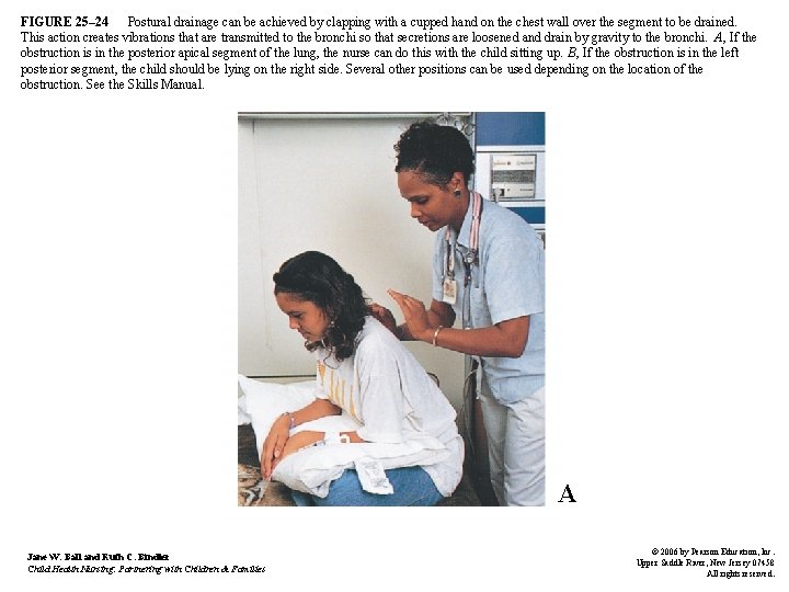 FIGURE 25– 24 Postural drainage can be achieved by clapping with a cupped hand