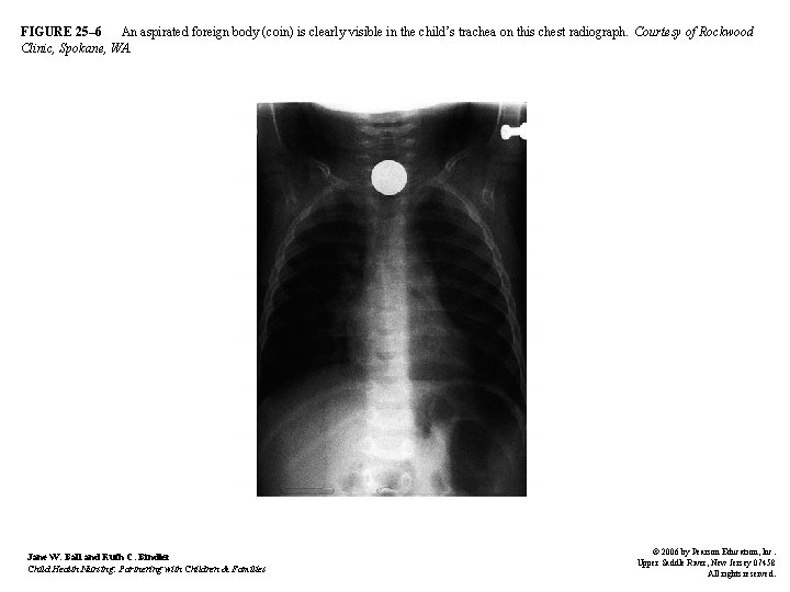 FIGURE 25– 6 An aspirated foreign body (coin) is clearly visible in the child’s