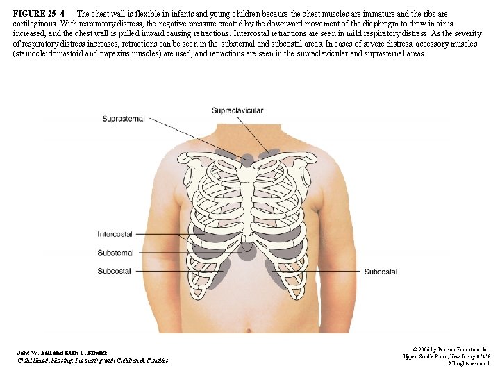 FIGURE 25– 4 The chest wall is flexible in infants and young children because