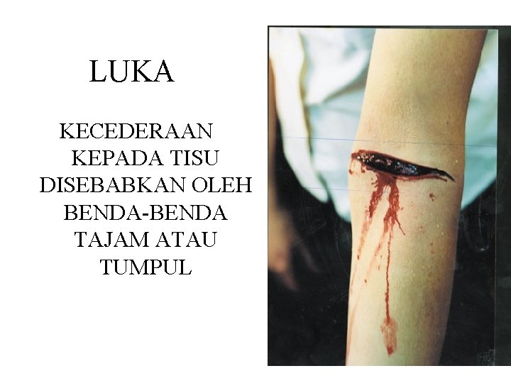 LUKA KECEDERAAN KEPADA TISU DISEBABKAN OLEH BENDA-BENDA TAJAM ATAU TUMPUL 