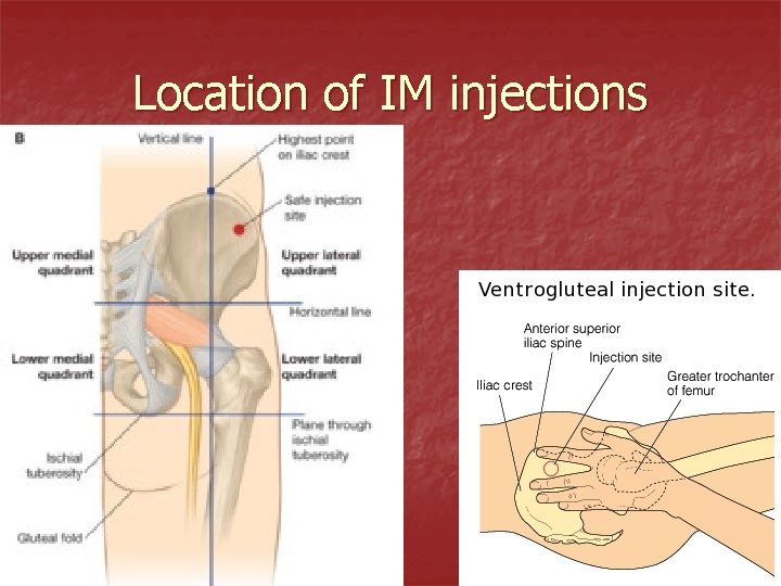 Location of IM injections 