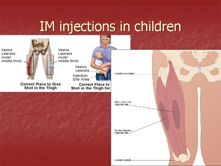 IM injections in children 
