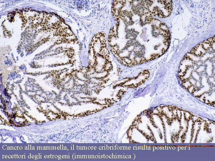 Cancro alla mammella, il tumore cribriforme risulta positivo per i recettori degli estrogeni (immunoistochimica