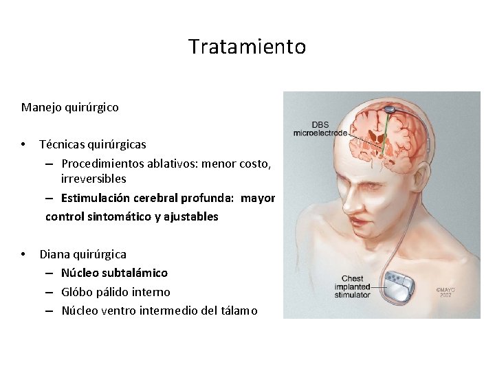 Tratamiento Manejo quirúrgico • Técnicas quirúrgicas – Procedimientos ablativos: menor costo, irreversibles – Estimulación