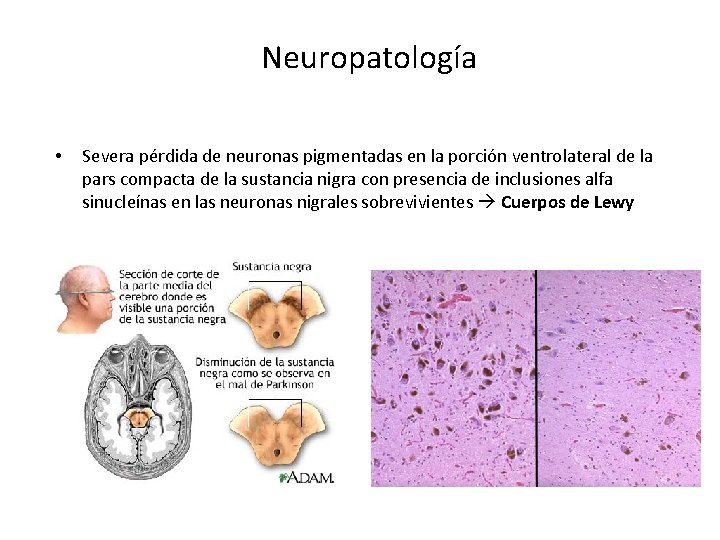 Neuropatología • Severa pérdida de neuronas pigmentadas en la porción ventrolateral de la pars