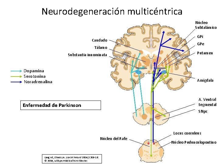 Neurodegeneración multicéntrica Núcleo Subtalámico GPi Caudado GPe Tálamo Putamen Substantia innominata Dopamina Serotonina Noradrenalina