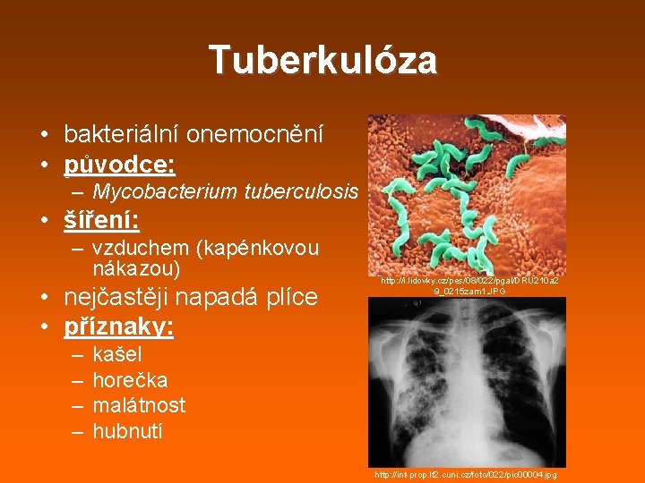 Tuberkulóza • bakteriální onemocnění • původce: – Mycobacterium tuberculosis • šíření: – vzduchem (kapénkovou Tuberkulóza • bakteriální onemocnění • původce: – Mycobacterium tuberculosis • šíření: – vzduchem (kapénkovou