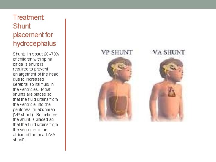 Treatment: Shunt placement for hydrocephalus Shunt: In about 60 -70% of children with spina