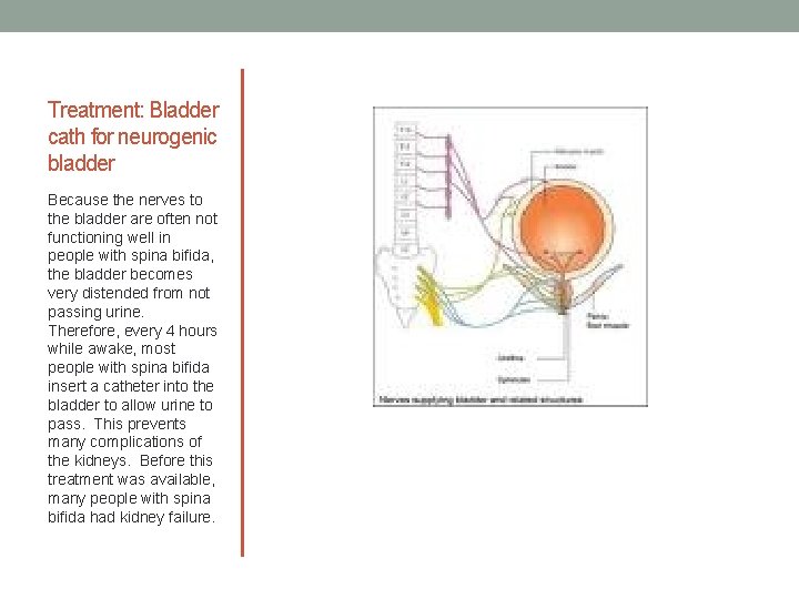 Treatment: Bladder cath for neurogenic bladder Because the nerves to the bladder are often